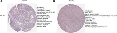 Identification of microtubule-associated biomarkers in diffuse large B-cell lymphoma and prognosis prediction